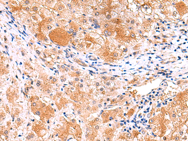 Immunohistochemistry of paraffin-embedded Human liver cancer tissue  using ITSN2 Polyclonal Antibody at dilution of 1:40(×200)