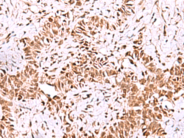 Immunohistochemistry of paraffin-embedded Human ovarian cancer tissue  using ISY1-RAB43 Polyclonal Antibody at dilution of 1:55(×200)