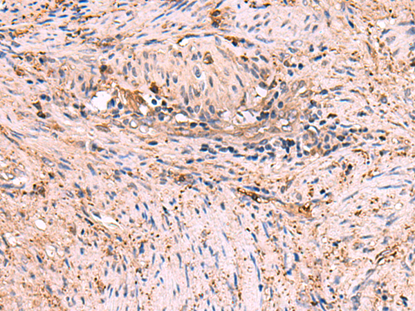 Immunohistochemistry of paraffin-embedded Human cervical cancer tissue  using MAPK8IP3 Polyclonal Antibody at dilution of 1:45(×200)