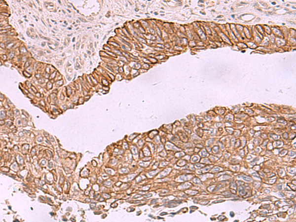 Immunohistochemistry of paraffin-embedded Human lung cancer tissue  using KCNK12 Polyclonal Antibody at dilution of 1:60(×200)