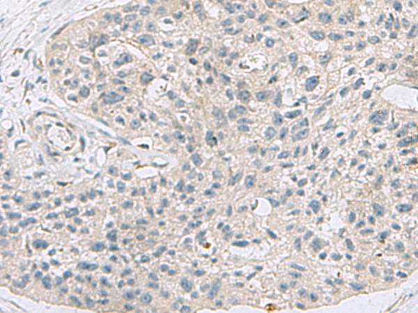 Immunohistochemistry of paraffin-embedded Human esophagus cancer tissue  using ABCA10 Polyclonal Antibody at dilution of 1:50(×200)