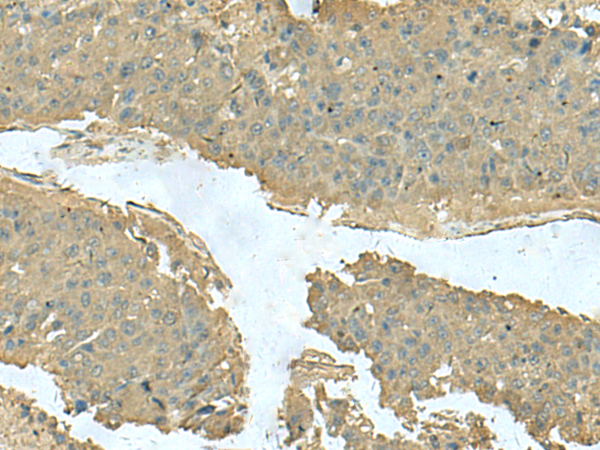 Immunohistochemistry of paraffin-embedded Human liver cancer tissue  using KRT36 Polyclonal Antibody at dilution of 1:50(×200)