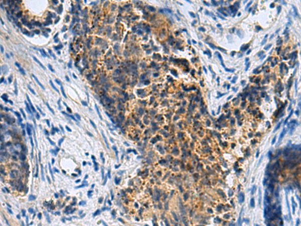 Immunohistochemistry of paraffin-embedded Human prost ate cancer tissue  using PLIN4 Polyclonal Antibody at dilution of 1:50(×200)