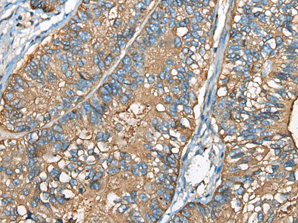 Immunohistochemistry of paraffin-embedded Human gastric cancer tissue  using CEACAM8 Polyclonal Antibody at dilution of 1:30(×200)