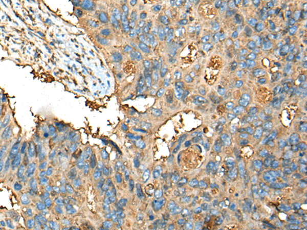 Immunohistochemistry of paraffin-embedded Human colorectal cancer tissue  using CEACAM8 Polyclonal Antibody at dilution of 1:30(×200)