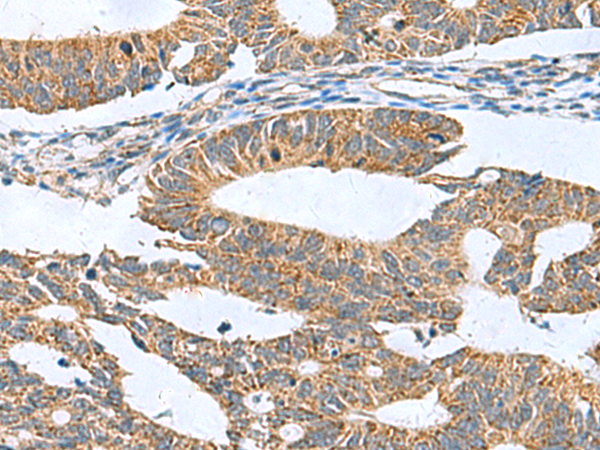 Immunohistochemistry of paraffin-embedded Human colorectal cancer tissue  using CLEC1B Polyclonal Antibody at dilution of 1:60(×200)