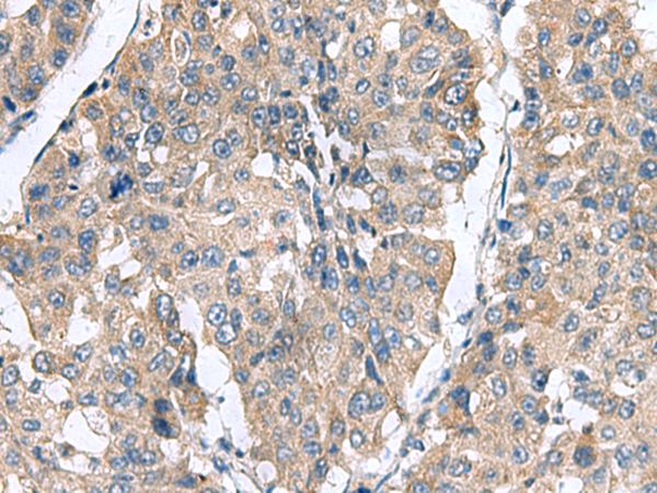 Immunohistochemistry of paraffin-embedded Human liver cancer tissue  using CLEC1B Polyclonal Antibody at dilution of 1:60(×200)