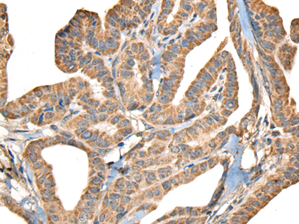 Immunohistochemistry of paraffin-embedded Human thyroid cancer tissue  using SLAMF7 Polyclonal Antibody at dilution of 1:30(×200)