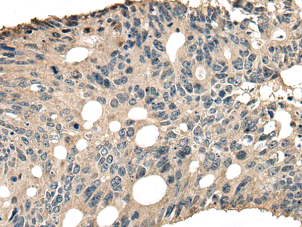 Immunohistochemistry of paraffin-embedded Human colorectal cancer tissue  using SLAMF7 Polyclonal Antibody at dilution of 1:30(×200)