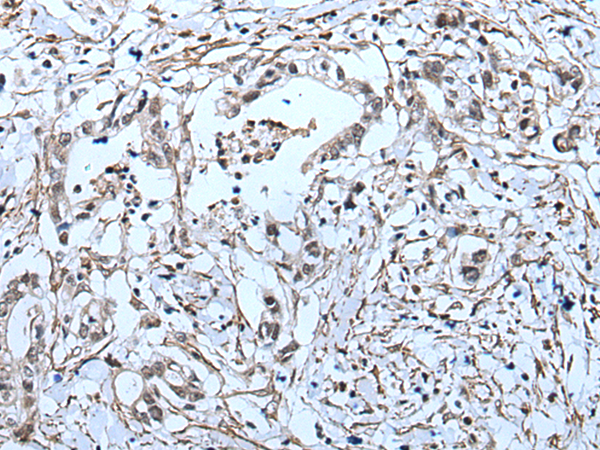 Immunohistochemistry of paraffin-embedded Human gastric cancer tissue  using GJA5 Polyclonal Antibody at dilution of 1:50(×200)