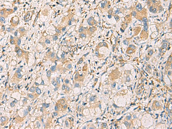 Immunohistochemistry of paraffin-embedded Human liver cancer tissue  using GNAZ Polyclonal Antibody at dilution of 1:70(×200)