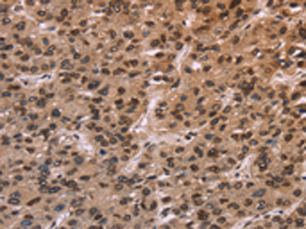 Immunohistochemistry of paraffin-embedded Human liver cancer tissue  using LMNB1 Polyclonal Antibody at dilution of 1:60(×200)