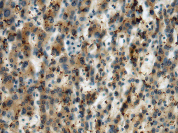 Immunohistochemistry of paraffin-embedded Human liver cancer tissue  using MICA Polyclonal Antibody at dilution of 1:60(×200)