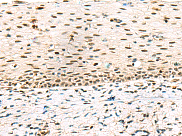 Immunohistochemistry of paraffin-embedded Human cervical cancer tissue  using ABI2 Polyclonal Antibody at dilution of 1:45(×200)