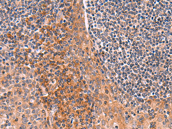 Immunohistochemistry of paraffin-embedded Human tonsil tissue  using ACYP1 Polyclonal Antibody at dilution of 1:65(×200)