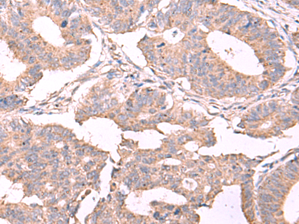 Immunohistochemistry of paraffin-embedded Human colorectal cancer tissue  using ESM1 Polyclonal Antibody at dilution of 1:50(×200)