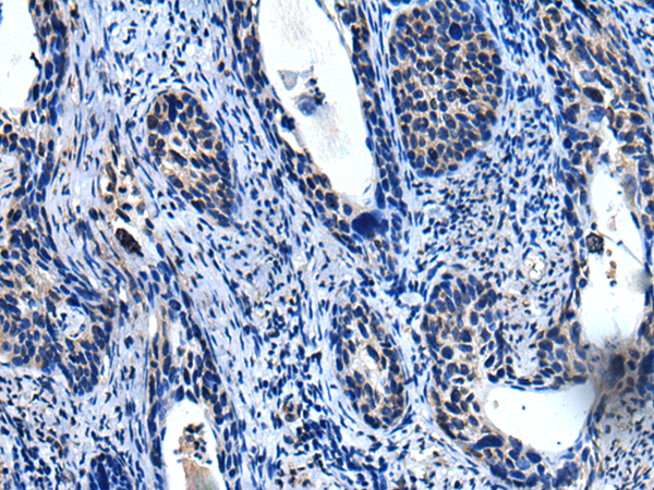 Immunohistochemistry of paraffin-embedded Human cervical cancer tissue  using TRIM23 Polyclonal Antibody at dilution of 1:55(×200)