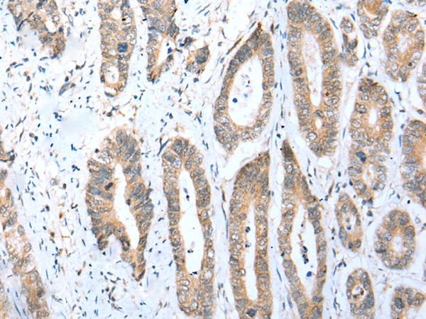 Immunohistochemistry of paraffin-embedded Human gastric cancer tissue  using ACBD4 Polyclonal Antibody at dilution of 1:30(×200)