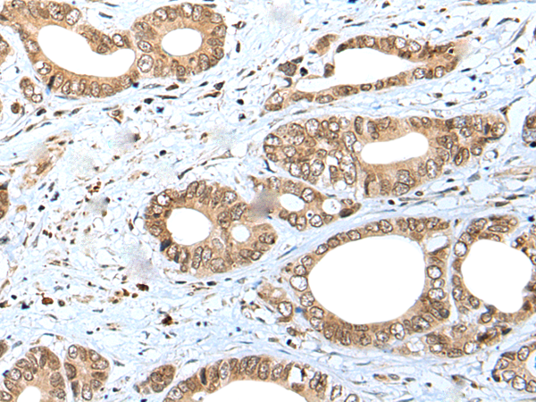 Immunohistochemistry of paraffin-embedded Human gastric cancer tissue  using SPCS2 Polyclonal Antibody at dilution of 1:40(×200)