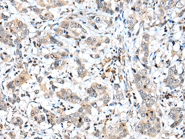 Immunohistochemistry of paraffin-embedded Human breast cancer tissue  using SPCS2 Polyclonal Antibody at dilution of 1:40(×200)