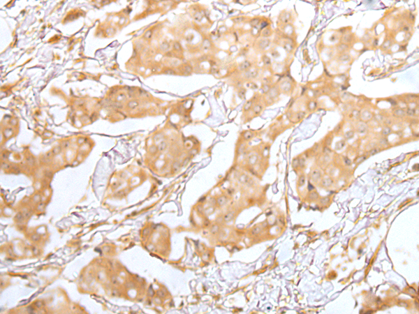 Immunohistochemistry of paraffin-embedded Human breast cancer tissue  using GRAP Polyclonal Antibody at dilution of 1:40(×200)