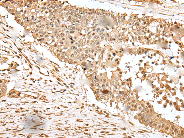 Immunohistochemistry of paraffin-embedded Human colorectal cancer tissue  using EEF1E1 Polyclonal Antibody at dilution of 1:35(×200)