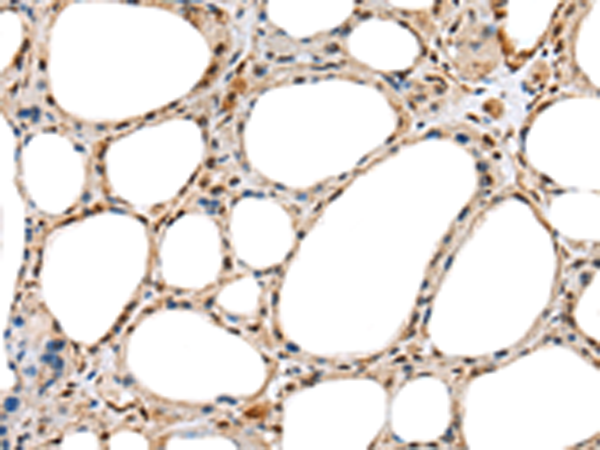 Immunohistochemistry of paraffin-embedded Human thyroid cancer tissue  using RAB11A Polyclonal Antibody at dilution of 1:35(×200)