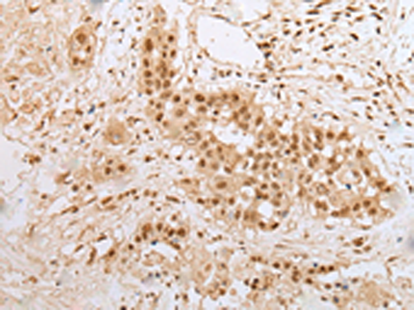 Immunohistochemistry of paraffin-embedded Human colorectal cancer tissue  using ZNF22 Polyclonal Antibody at dilution of 1:25(×200)