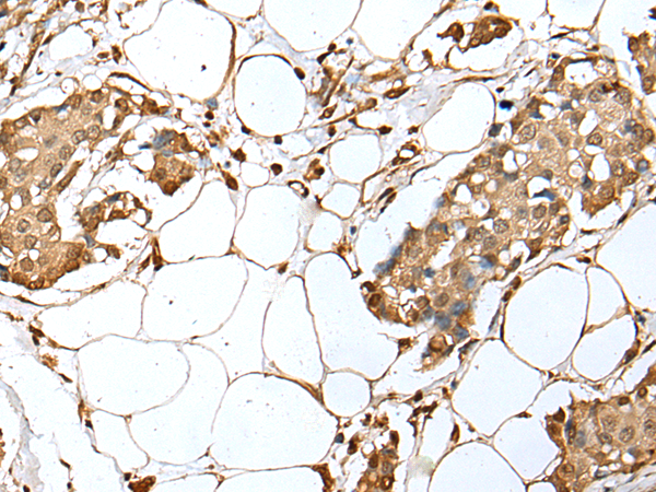 Immunohistochemistry of paraffin-embedded Human breast cancer tissue  using UBE2Z Polyclonal Antibody at dilution of 1:35(×200)