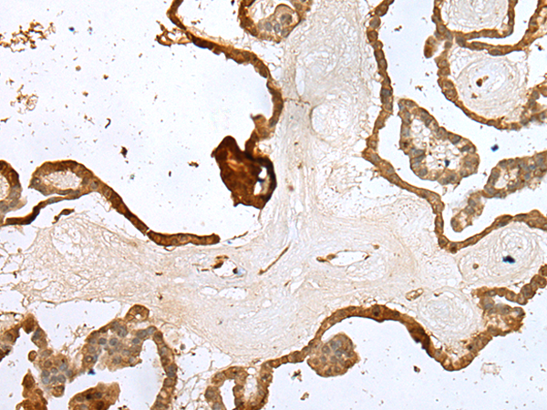 Immunohistochemistry of paraffin-embedded Human thyroid cancer tissue  using UBE2Z Polyclonal Antibody at dilution of 1:35(×200)