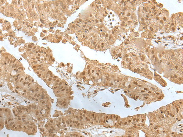 Immunohistochemistry of paraffin-embedded Human liver cancer tissue  using ZNF24 Polyclonal Antibody at dilution of 1:35(×200)