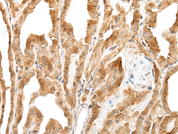 Immunohistochemistry of paraffin-embedded Human thyroid cancer tissue  using ZPBP Polyclonal Antibody at dilution of 1:30(×200)