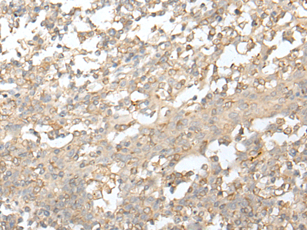 Immunohistochemistry of paraffin-embedded Human tonsil tissue  using ZZZ3 Polyclonal Antibody at dilution of 1:50(×200)