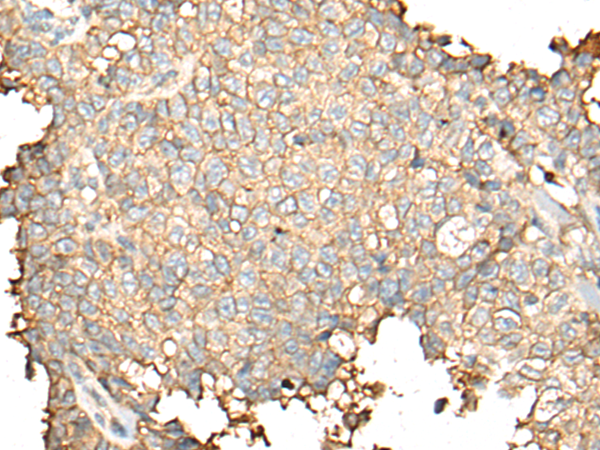 Immunohistochemistry of paraffin-embedded Human ovarian cancer tissue  using CD55 Polyclonal Antibody at dilution of 1:35(×200)