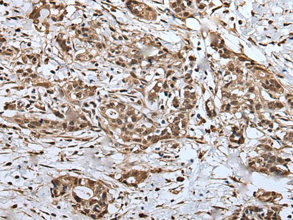 Immunohistochemistry of paraffin-embedded Human gastric cancer tissue  using UPK3A Polyclonal Antibody at dilution of 1:30(×200)