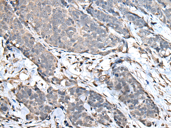 Immunohistochemistry of paraffin-embedded Human thyroid cancer tissue  using UPK3A Polyclonal Antibody at dilution of 1:30(×200)