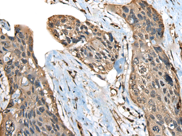 Immunohistochemistry of paraffin-embedded Human esophagus cancer tissue  using ATXN3 Polyclonal Antibody at dilution of 1:100(×200)