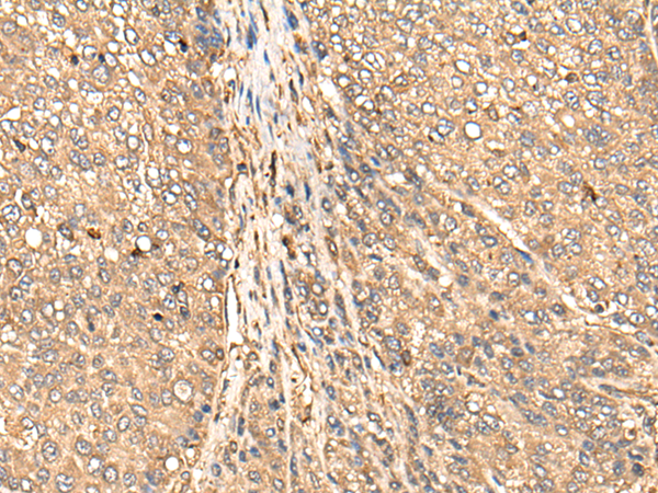 Immunohistochemistry of paraffin-embedded Human liver cancer tissue  using BAIAP2L1 Polyclonal Antibody at dilution of 1:45(×200)