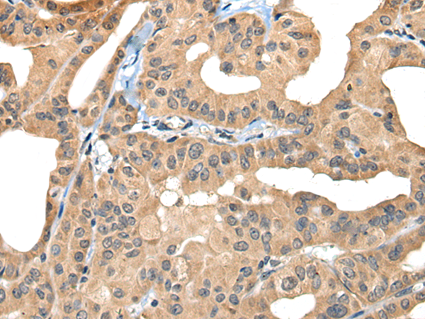 Immunohistochemistry of paraffin-embedded Human thyroid cancer tissue  using BHMT2 Polyclonal Antibody at dilution of 1:30(×200)