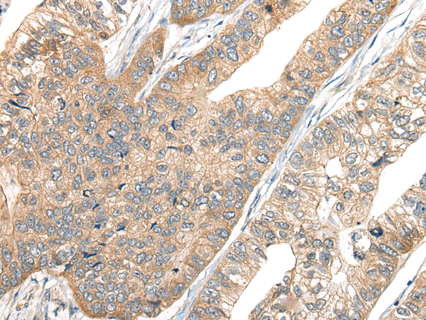 Immunohistochemistry of paraffin-embedded Human gastric cancer tissue  using CA7 Polyclonal Antibody at dilution of 1:50(×200)