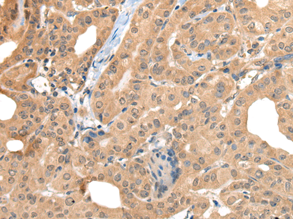 Immunohistochemistry of paraffin-embedded Human thyroid cancer tissue  using CA7 Polyclonal Antibody at dilution of 1:50(×200)