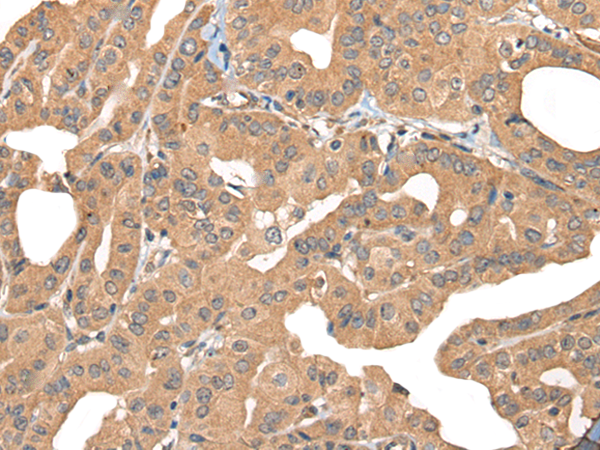 Immunohistochemistry of paraffin-embedded Human thyroid cancer tissue  using PPP3R1 Polyclonal Antibody at dilution of 1:55(×200)
