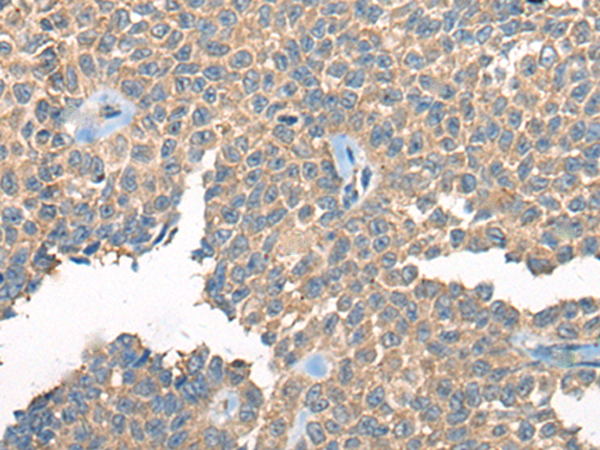 Immunohistochemistry of paraffin-embedded Human ovarian cancer tissue  using PPP3R1 Polyclonal Antibody at dilution of 1:55(×200)