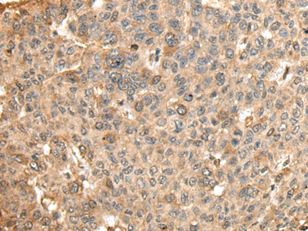 Immunohistochemistry of paraffin-embedded Human liver cancer tissue  using HMMR Polyclonal Antibody at dilution of 1:45(×200)
