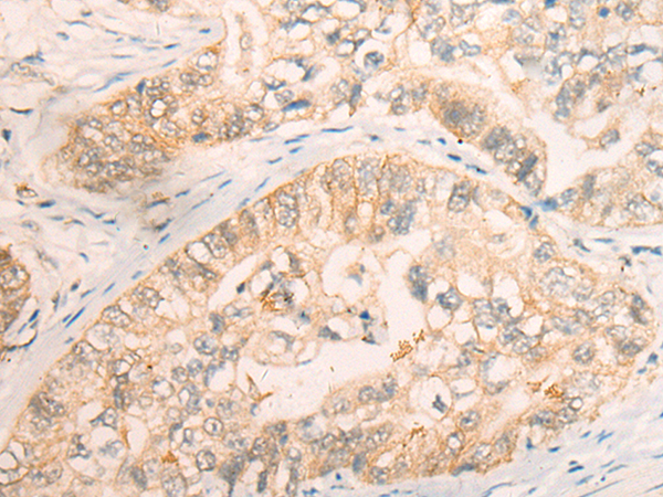 Immunohistochemistry of paraffin-embedded Human gastric cancer tissue  using CD86 Polyclonal Antibody at dilution of 1:30(×200)