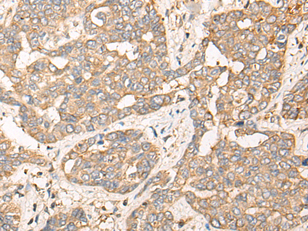Immunohistochemistry of paraffin-embedded Human liver cancer tissue  using CPNE3 Polyclonal Antibody at dilution of 1:40(×200)