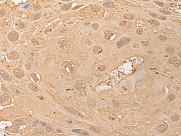Immunohistochemistry of paraffin-embedded Human esophagus cancer tissue  using CPNE3 Polyclonal Antibody at dilution of 1:40(×200)