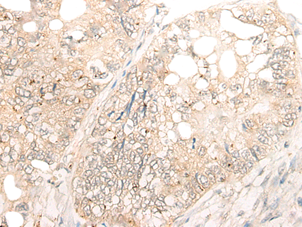 Immunohistochemistry of paraffin-embedded Human gastric cancer tissue  using DCP2 Polyclonal Antibody at dilution of 1:45(×200)