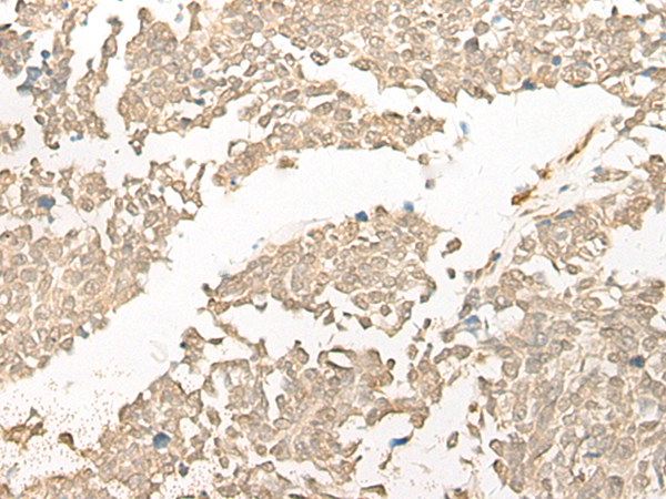 Immunohistochemistry of paraffin-embedded Human lung cancer tissue  using COMT Polyclonal Antibody at dilution of 1:25(×200)