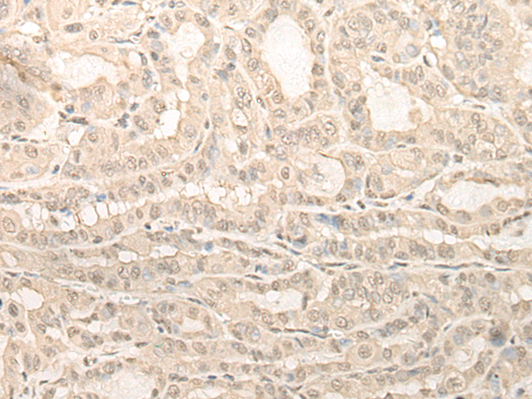 Immunohistochemistry of paraffin-embedded Human thyroid cancer tissue  using UBXN1 Polyclonal Antibody at dilution of 1:35(×200)